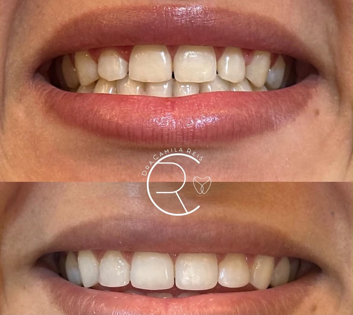 Resultado de tratamento — antes e depois
